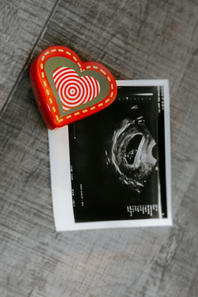 Pregnancy after PCOS diagnosis: an image of an ultrasound showing baby, with a heart magnet next to it.