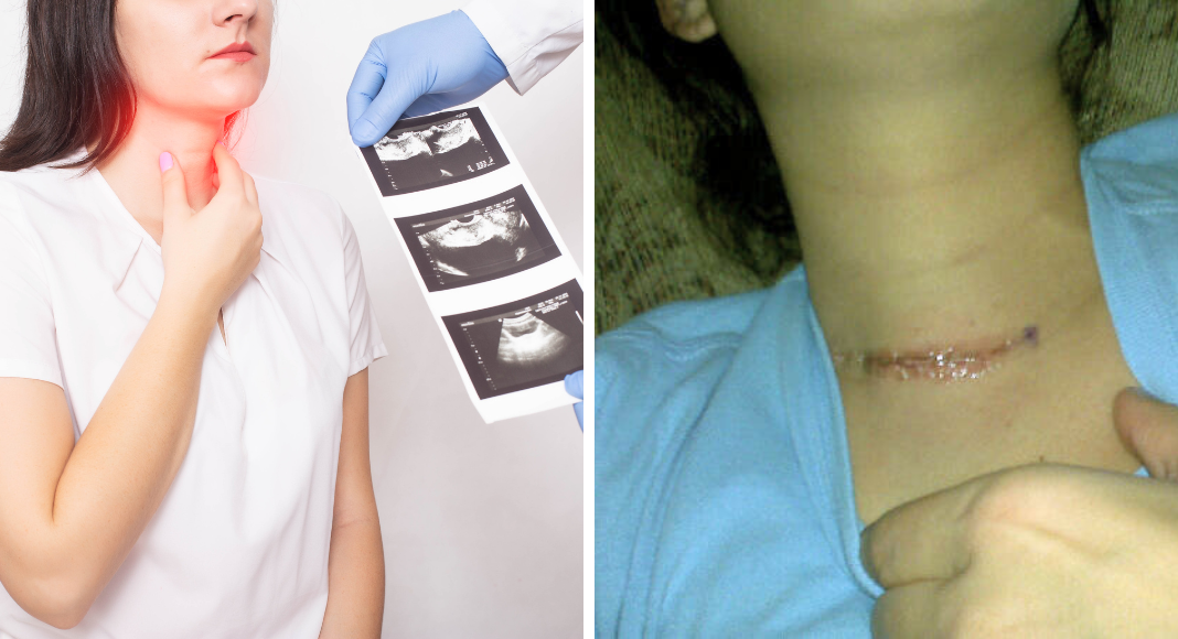 Photo on left: a woman holds her neck while a doctor holds up a sheet of thyroid ultrasound images. Photo on right: a woman shows a scar across the base of her neck.